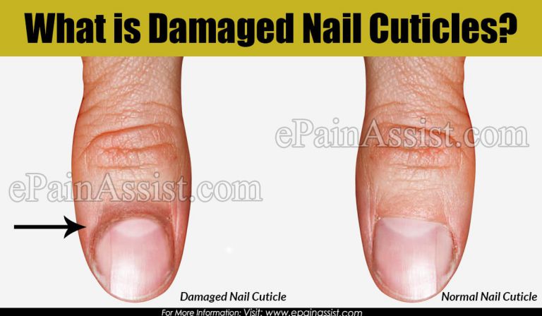 What Causes Damaged Nail Cuticles & How to Treat it?