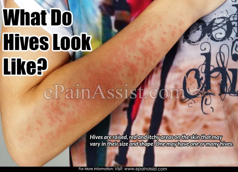 What Do Hives Look Like & How Long Does It Take For Hives To Fully Go Away?