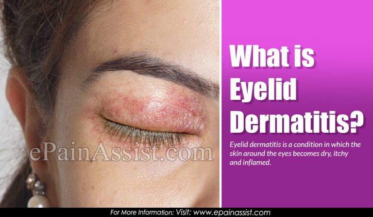 Eyelid Dermatitis: Causes, Symptoms, Treatments, Diagnosis, How long Does It Last?