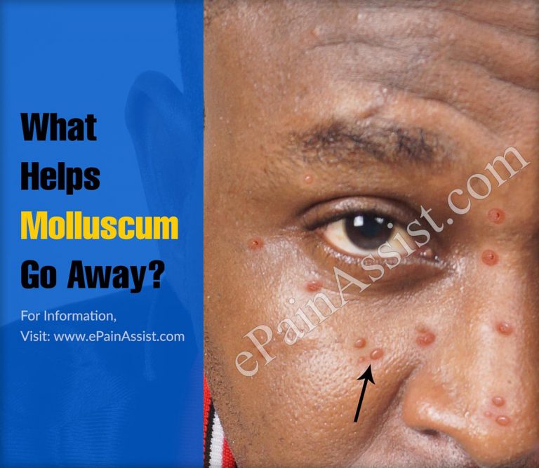 What Helps Molluscum Go Away?