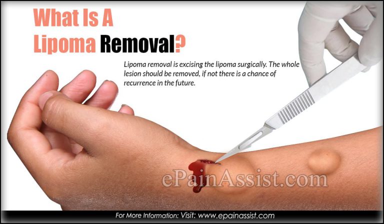 What Is A Lipoma Removal?