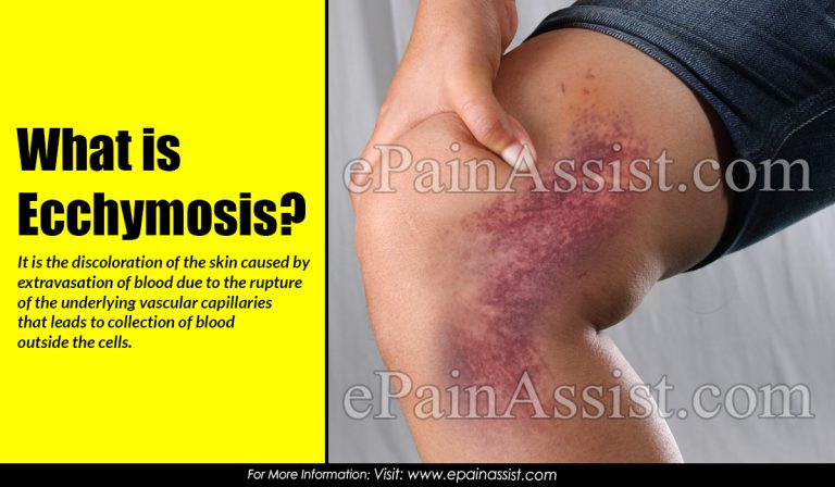 What is Ecchymosis & How Long Does It Last?