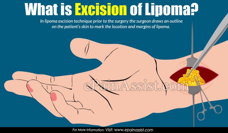 What Is Excision Of Lipoma?
