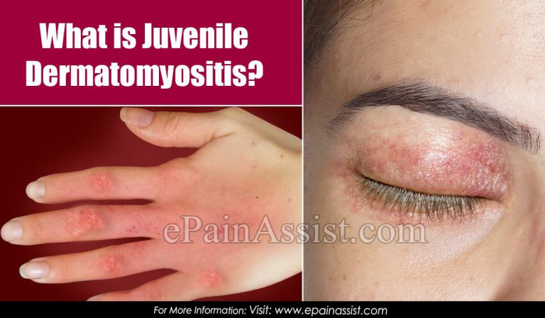 What Is Juvenile Dermatomyositis & How Is It Treated?|Causes, Symptoms, Prognosis of Juvenile Dermatomyositis