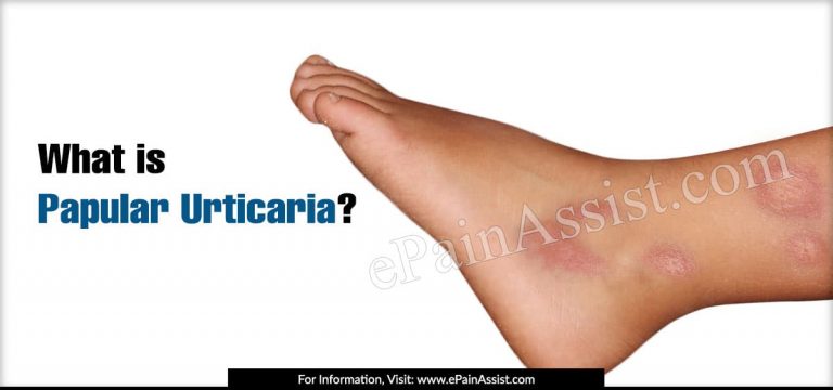 Papular Urticaria: Causes & Treatment