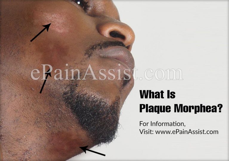 What Is Plaque Morphea?