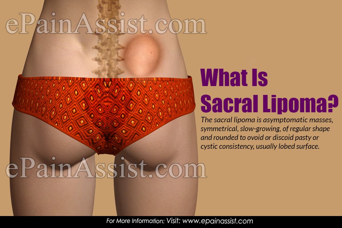 What Is Sacral Lipoma?