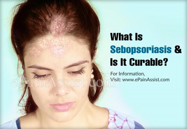 What Is Sebopsoriasis & Is It Curable?|Symptoms, Treatment of Sebopsoriasis
