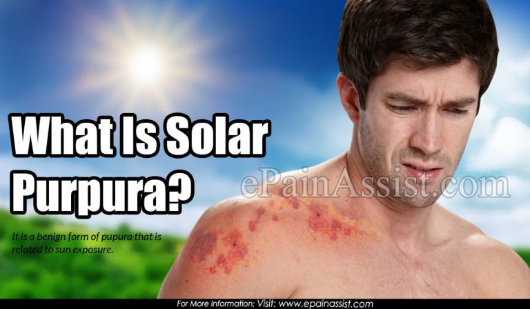 What is Solar Purpura & How is it Treated?| Causes, Signs, Symptoms, Prevention of  Solar Purpura