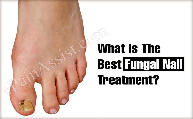 What Is The Best Fungal Nail Treatment?