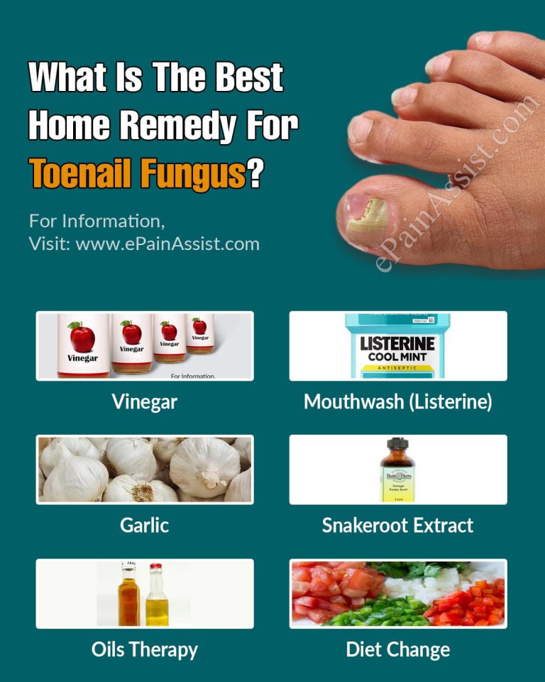 What Is The Best Home Remedy For Toenail Fungus?