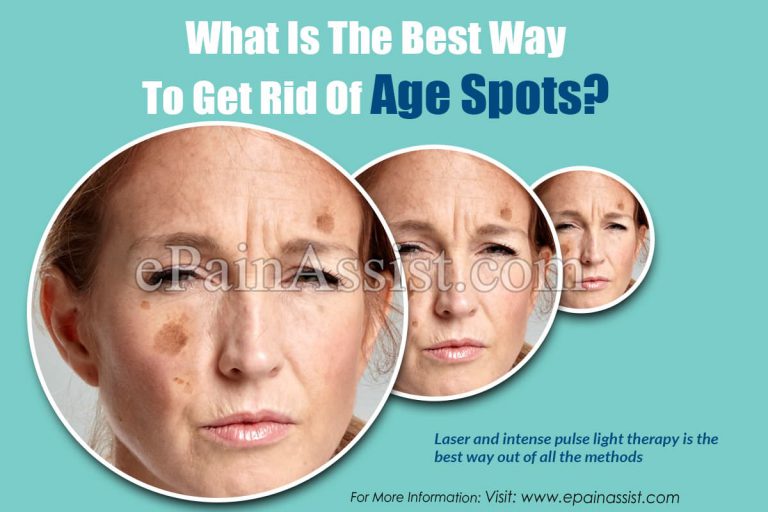 What Is The Best Way To Get Rid Of Age Spots?