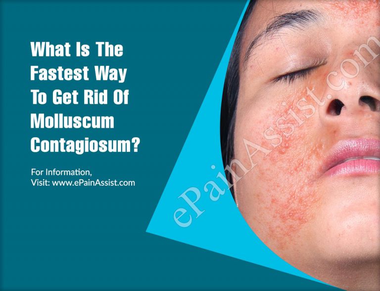 What Is The Fastest Way To Get Rid Of Molluscum Contagiosum?