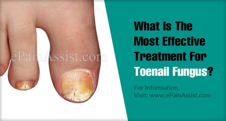 What Is The Most Effective Treatment For Toenail Fungus?