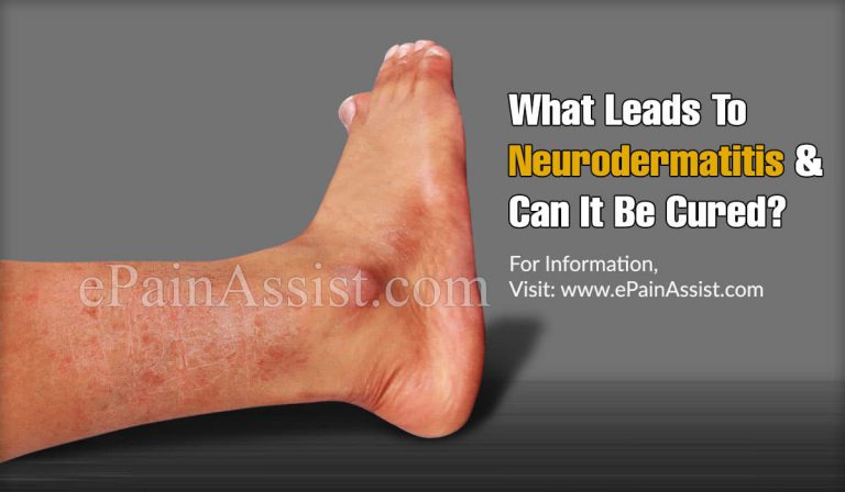 What Leads To Neurodermatitis & Can It Be Cured?