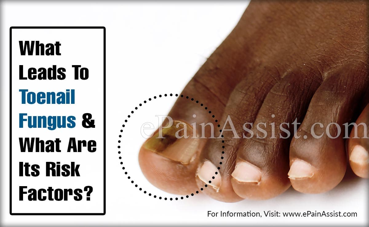 What Leads To Toenail Fungus & What Are Its Risk Factors?