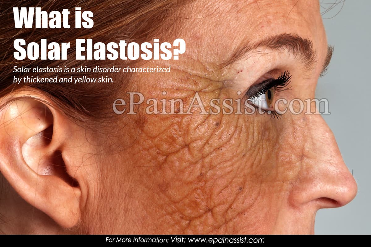 What is Solar Elastosis?