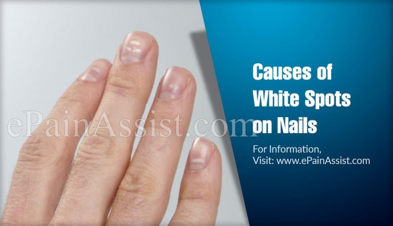 White Spots on Nails: Causes, Types, Treatment, Natural Remedies, Prevention, Diagnosis