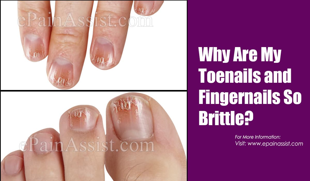 Why Are My Toenails and Fingernails So Brittle? Why Are My Toenails and Fingernails So Brittle?
