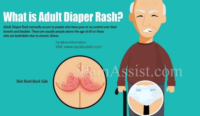 Adult Diaper Rash: Causes & Treatment