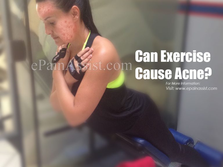 Can Exercise Cause Acne?