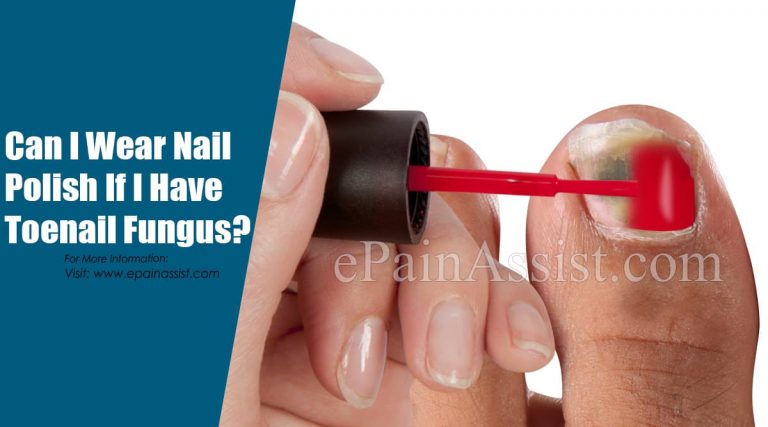 Can I Wear Nail Polish If I Have Toenail Fungus?