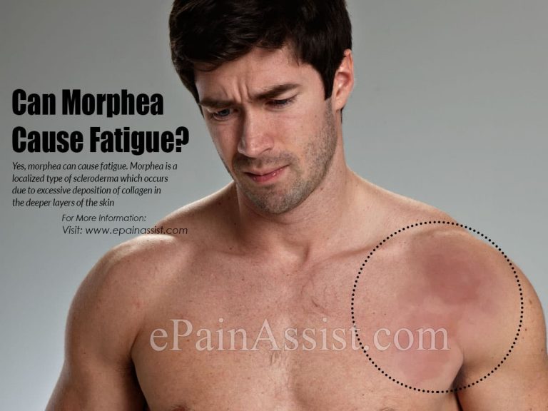 Can Morphea Cause Fatigue?