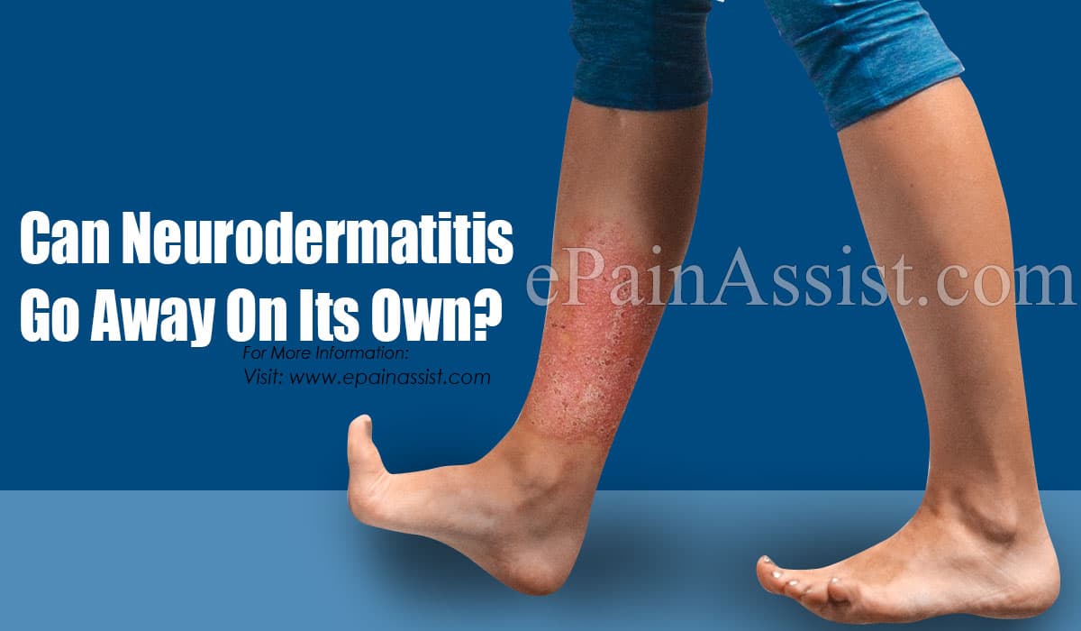 Can Neurodermatitis Go Away On Its Own