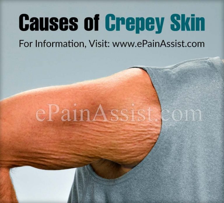 What Causes Crepey Skin, Know Its Prevention & Treatment