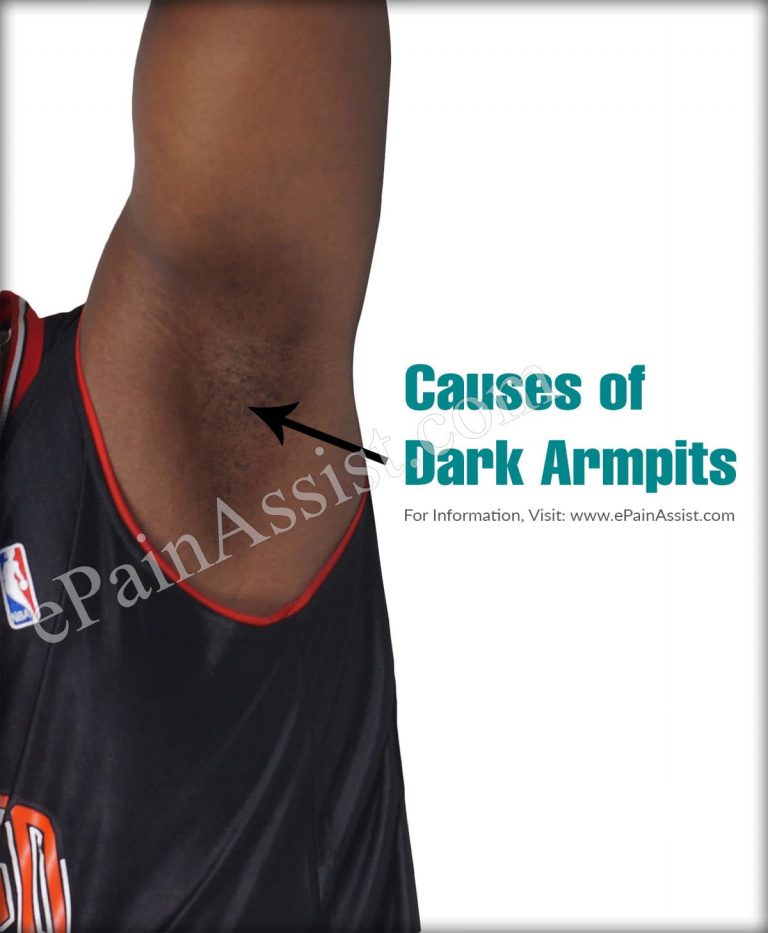 Dark Armpits – Causes and Treatment