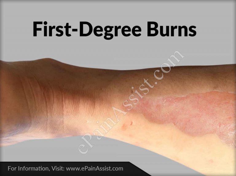 First-Degree Burns