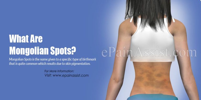 How Common Are Mongolian Spots & Do They Pose A Health Risk? | Causes & Treatment of Mongolian Spots