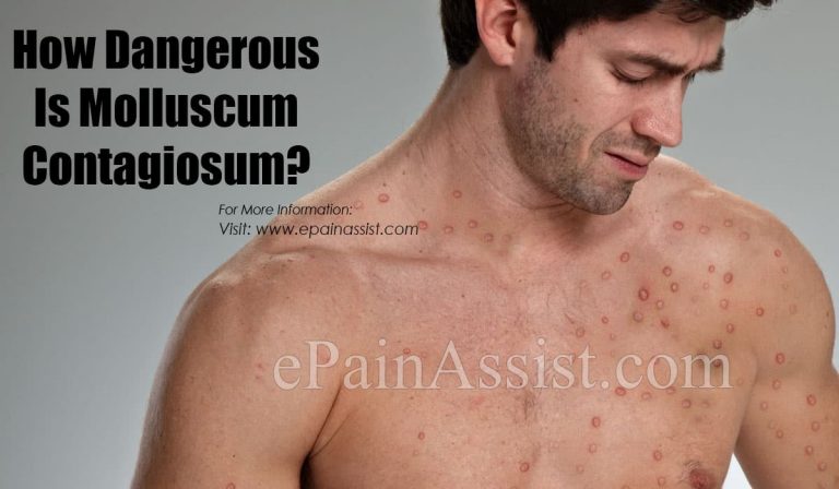 How Dangerous Is Molluscum Contagiosum?