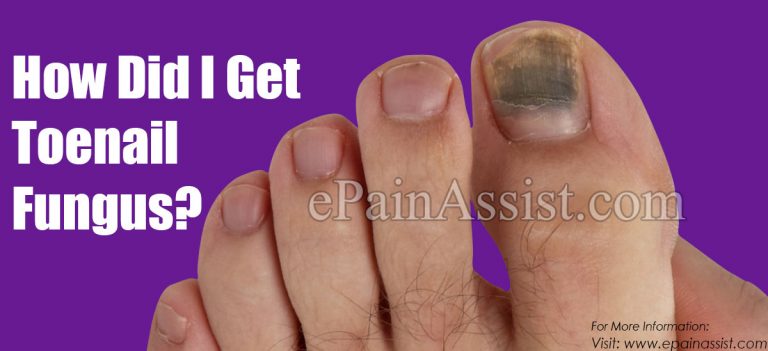 How Did I Get Toenail Fungus?
