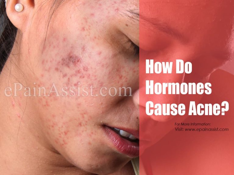 How & Why Do Hormones Cause Acne?