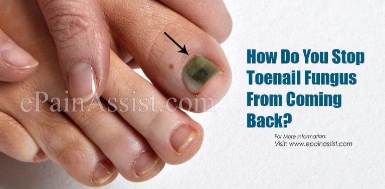 How Do You Stop Toenail Fungus From Coming Back?
