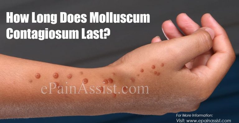 How Long Does Molluscum Contagiosum Last?