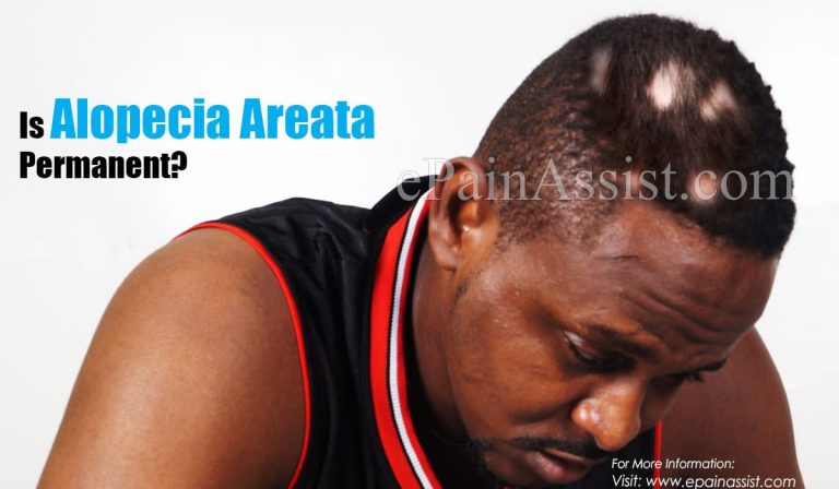 Is Alopecia Areata Permanent?