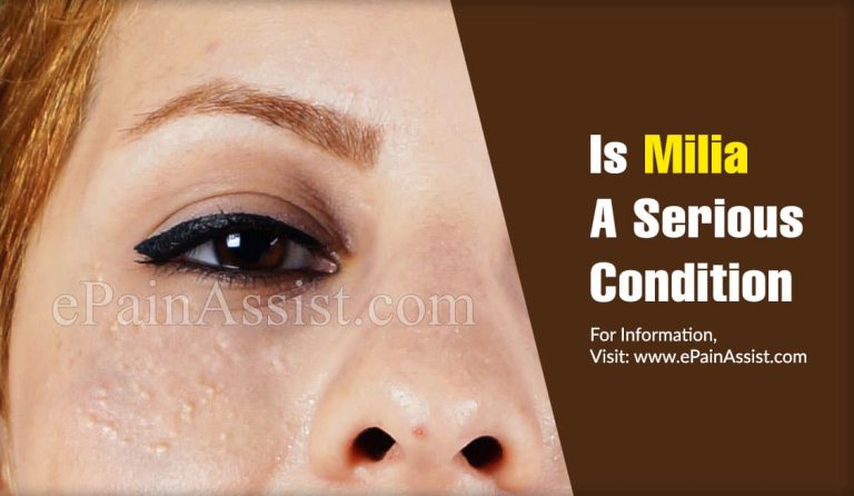 Is Milia A Serious Condition?