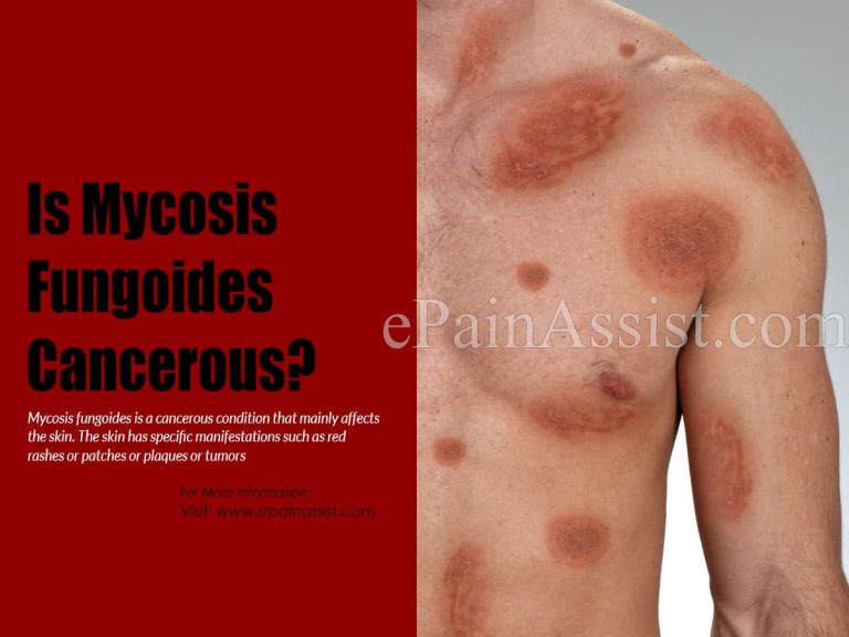 Is Mycosis Fungoides Cancerous?