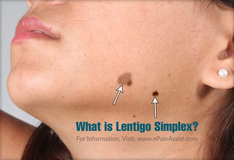 What is Lentigo Simplex: Causes, Risk Factors, Symptoms, Treatment, How is it Different From Melanoma?