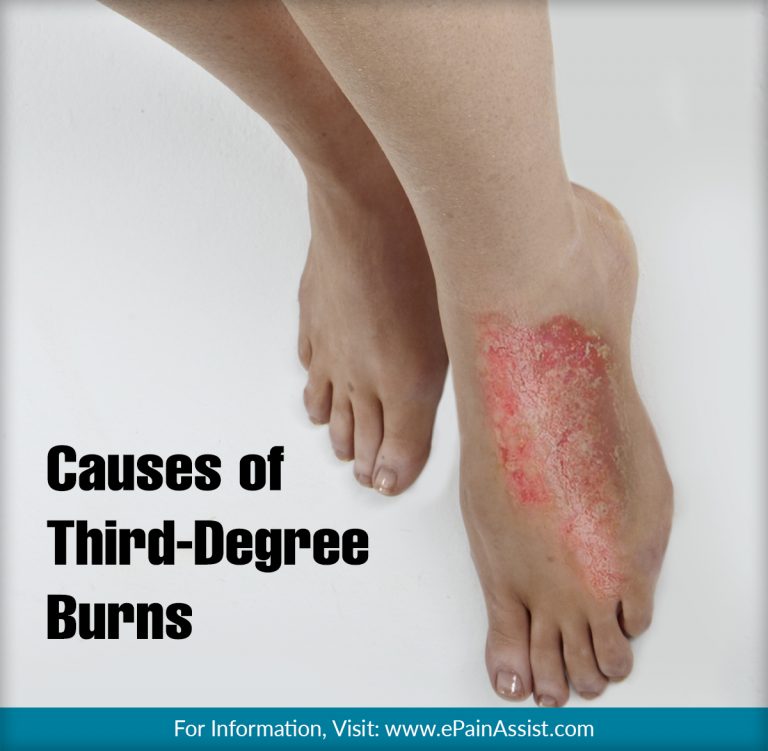 All You Need To Know About Third-Degree Burns