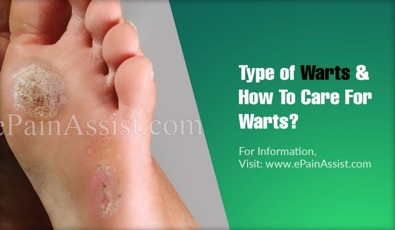 Type of Warts & How To Care For Warts?