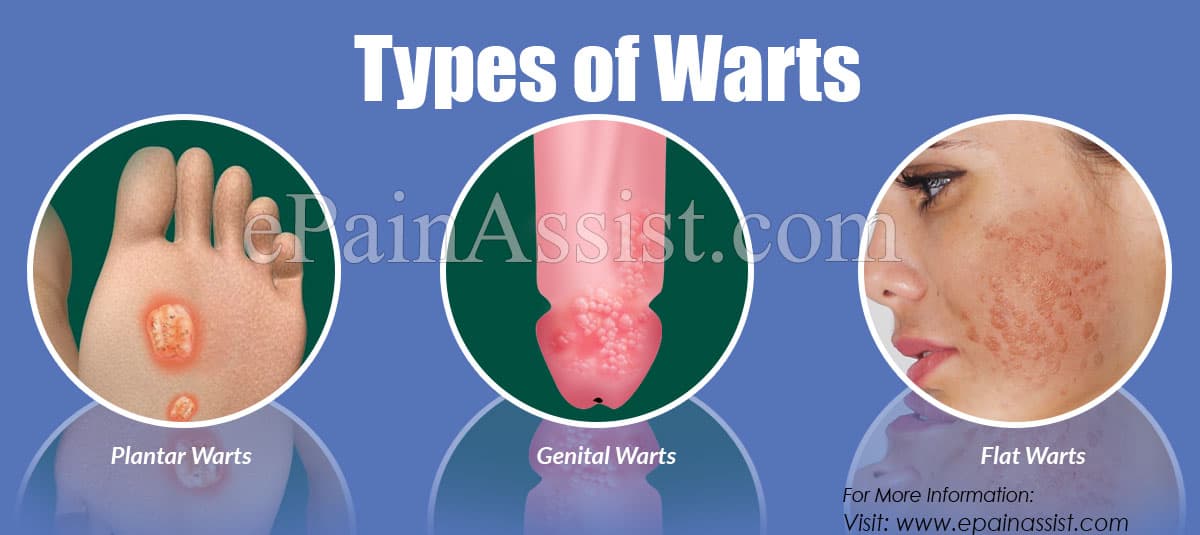 Types of Warts