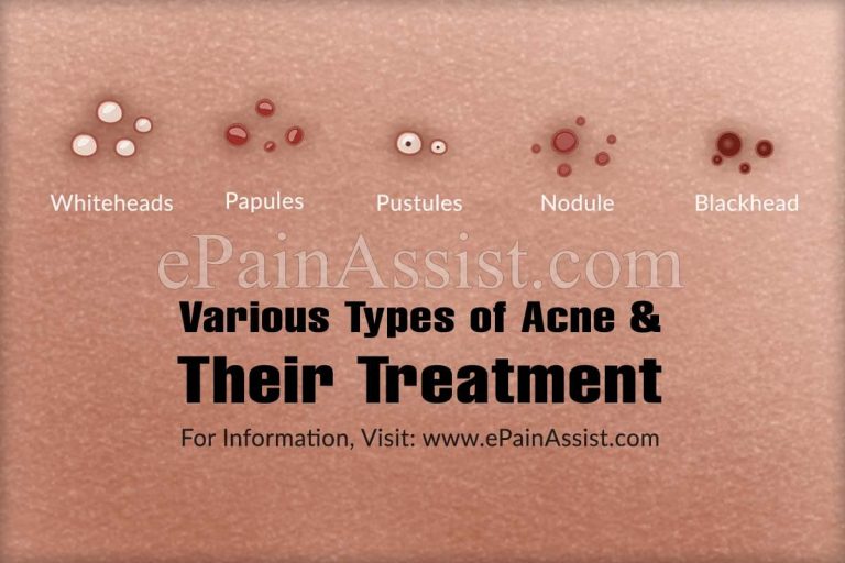 Various Types of Acne, Severity, and Their Treatments