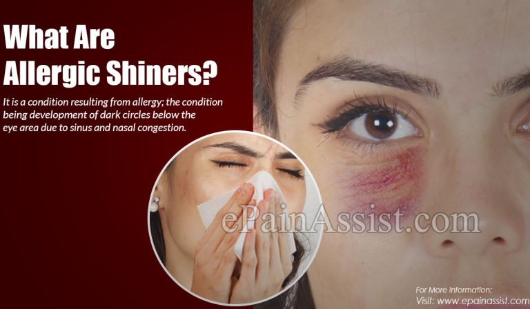 What Are Allergic Shiners: Risk, Causes, Symptoms, Treatment, Lifestyle Changes