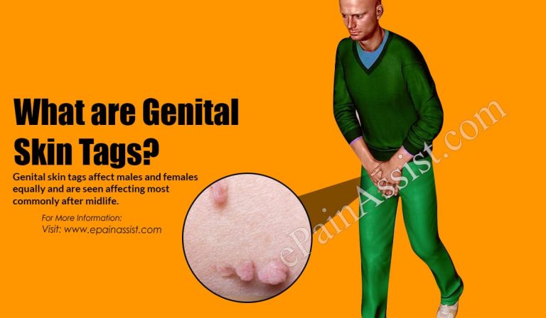 What Are Genital Skin Tags & Can They Turn Cancerous?