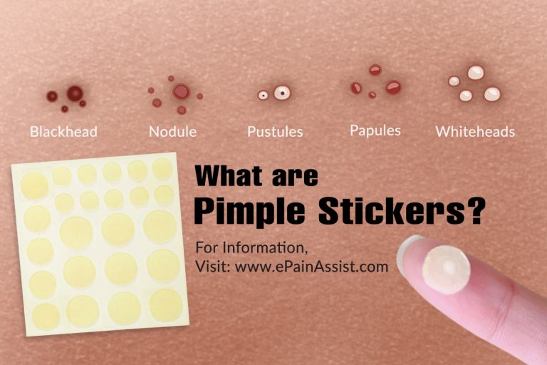 What are Pimple Stickers & How Does It Work?
