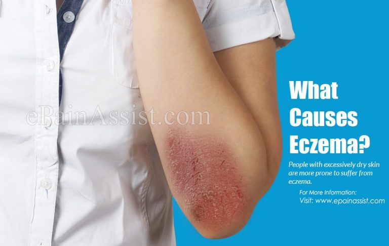 What Causes Eczema & Is It Contagious?