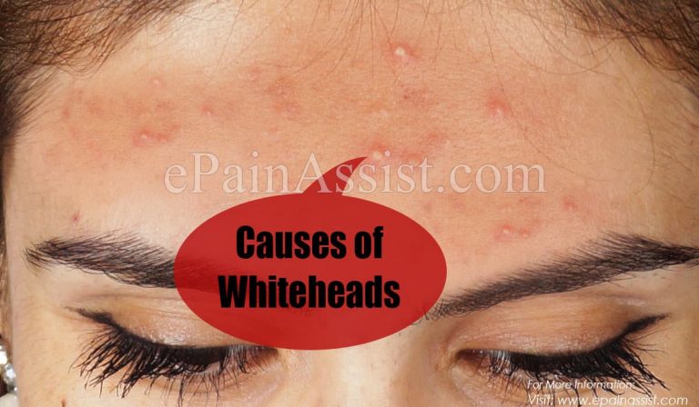 What Causes Whiteheads & How To Get Rid Of Them?